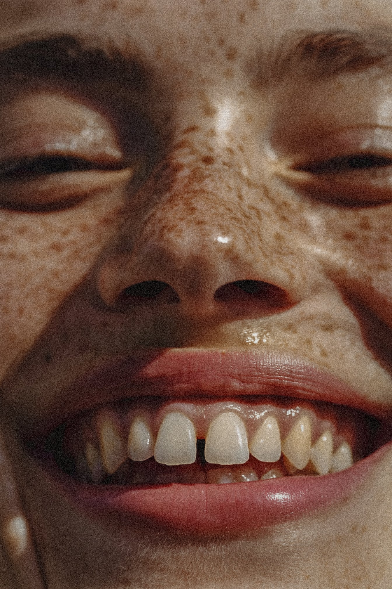 Freckles or moles. When the answer is a GP, and when it's laser.