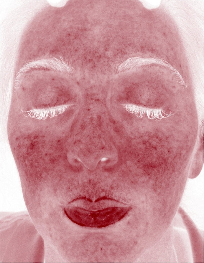 Front, at baseline. VISIA red channel. Identifying details removed at the editorial layer.
