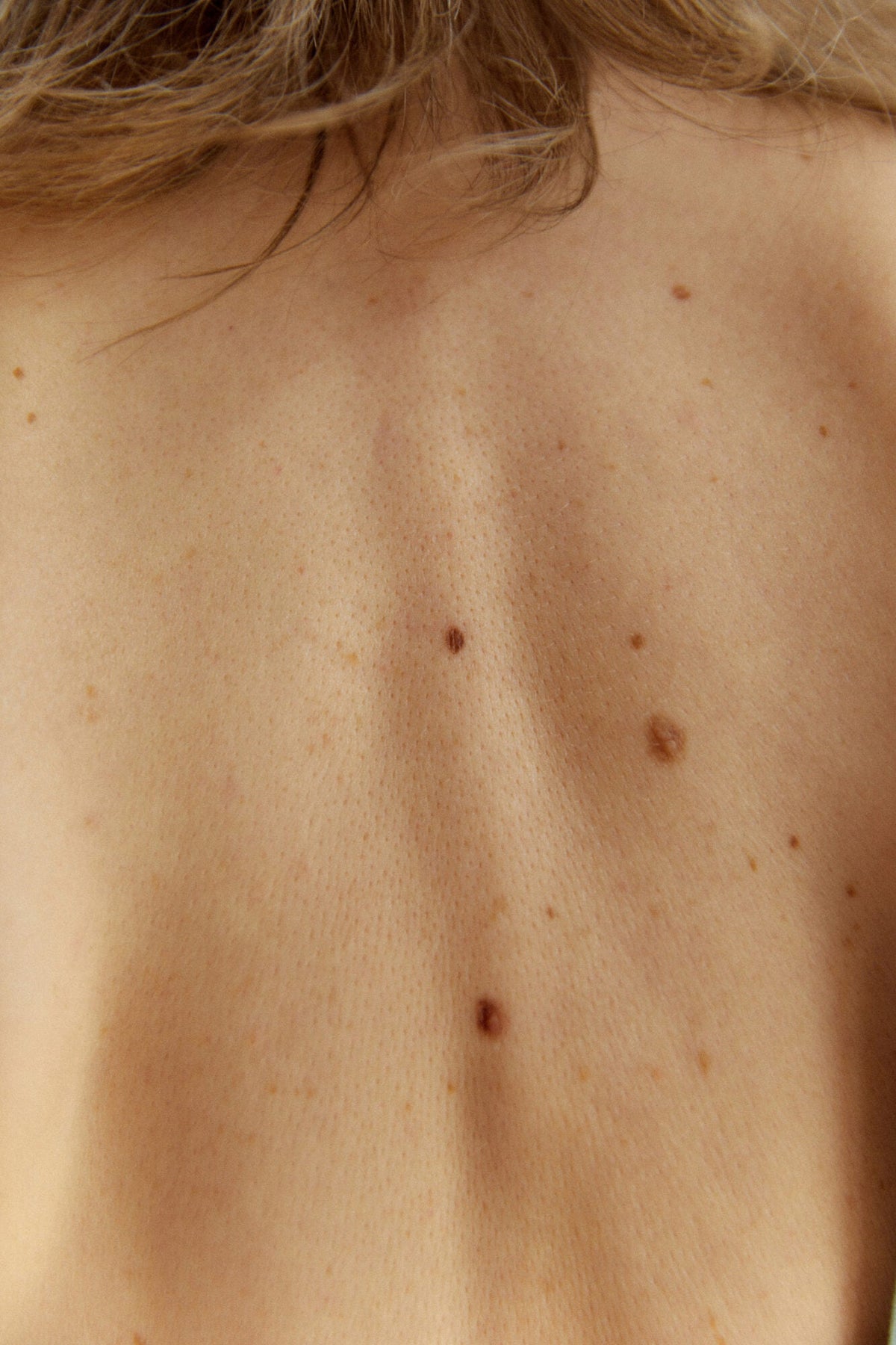 Bare back and shoulder in natural light with raised spots on the skin. Seborrhoeic keratosis, Pink Laser Clinics.