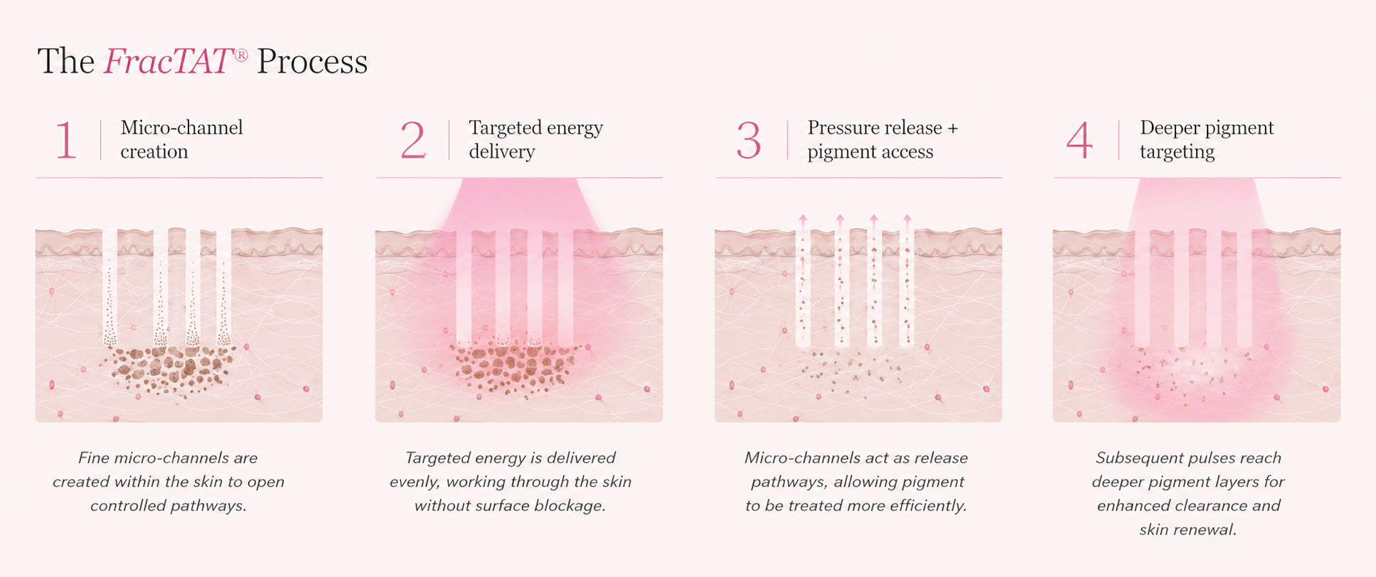 Diagram showing how the FracTAT procedure lifts tattoo ink in a single visit