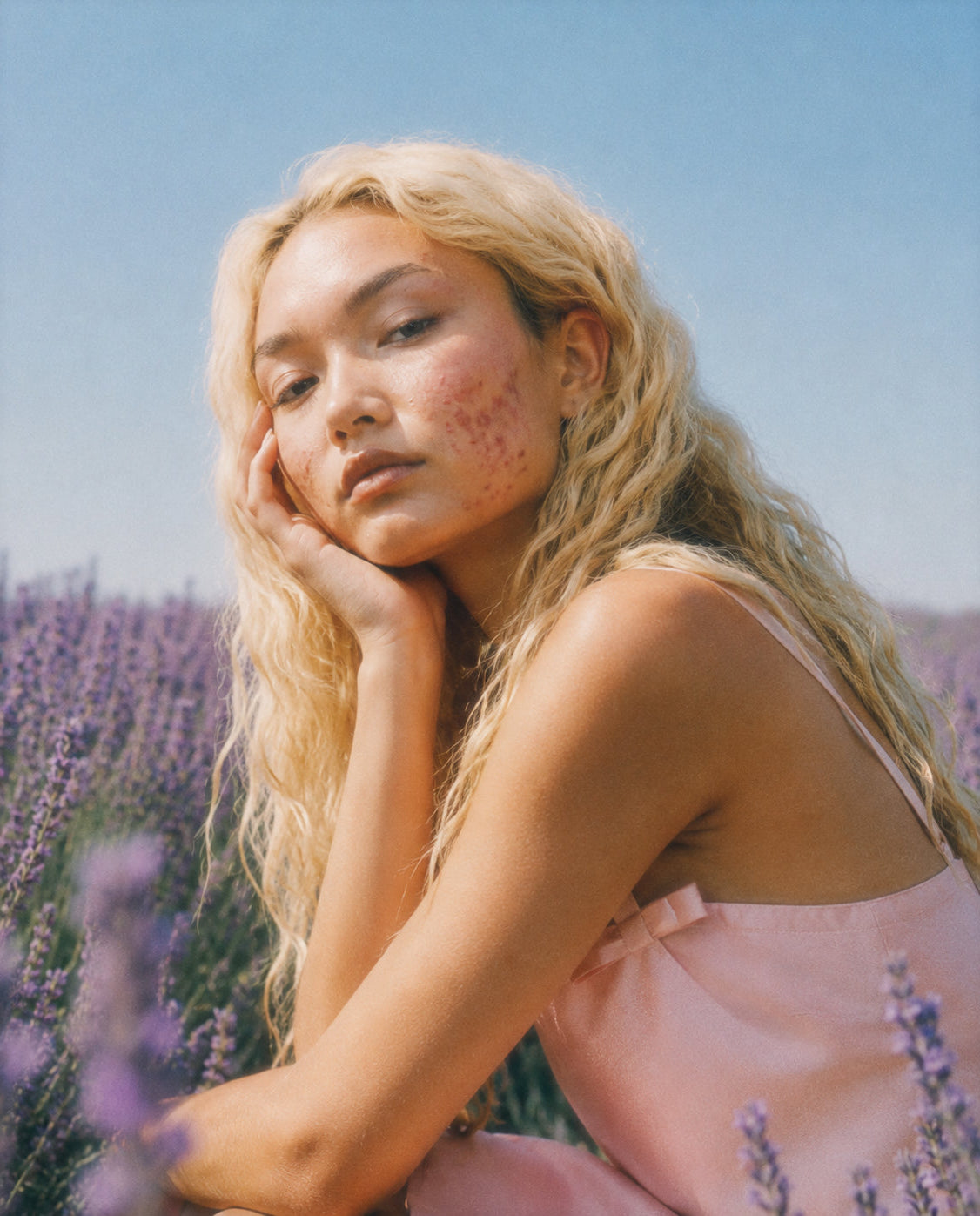 Pink Laser Clinics active acne patient portrait, Doncaster Melbourne
