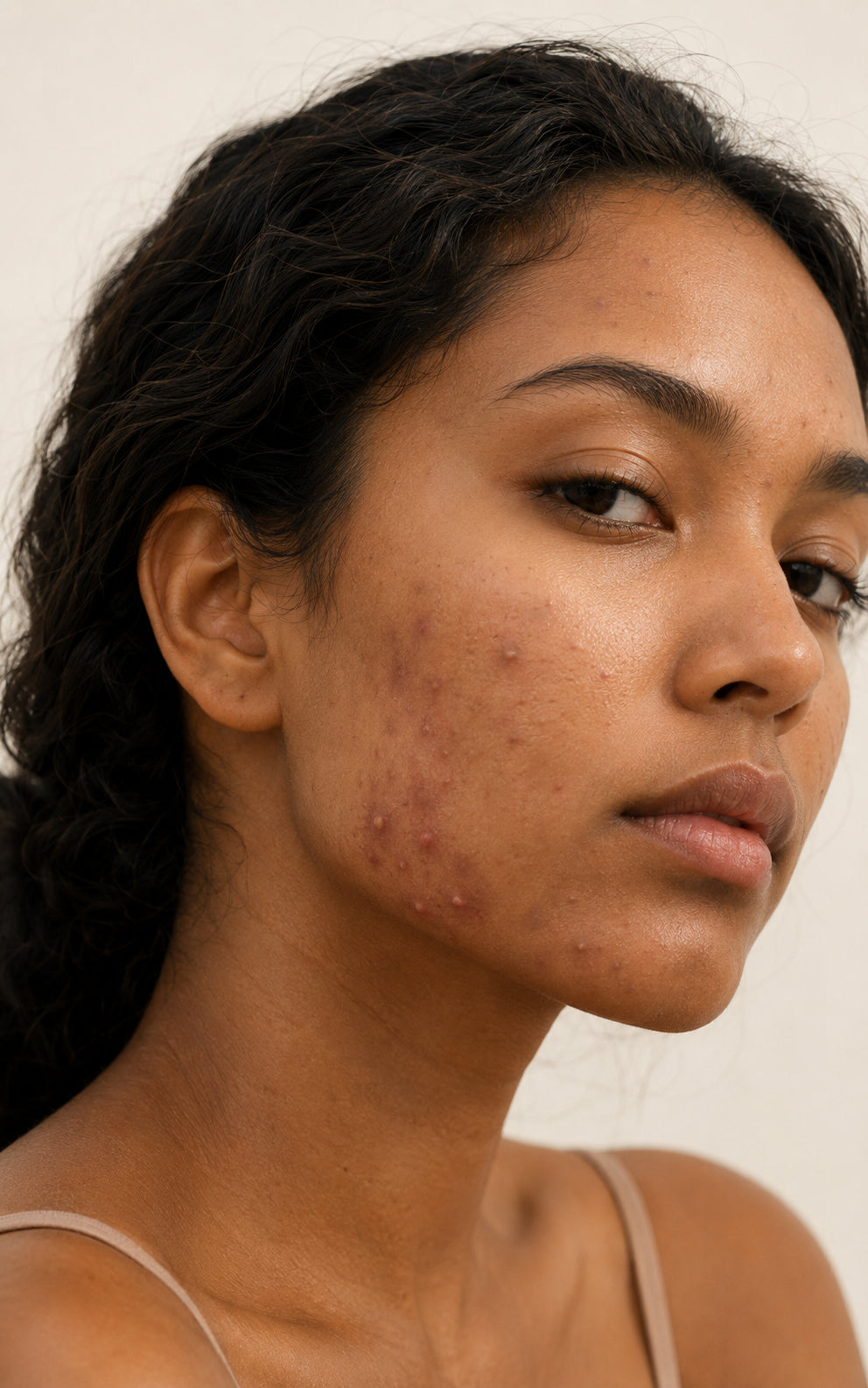 Inflammatory papular and pustular acne, Fitzpatrick V skin, close-up showing red and yellow active lesions on the cheek
