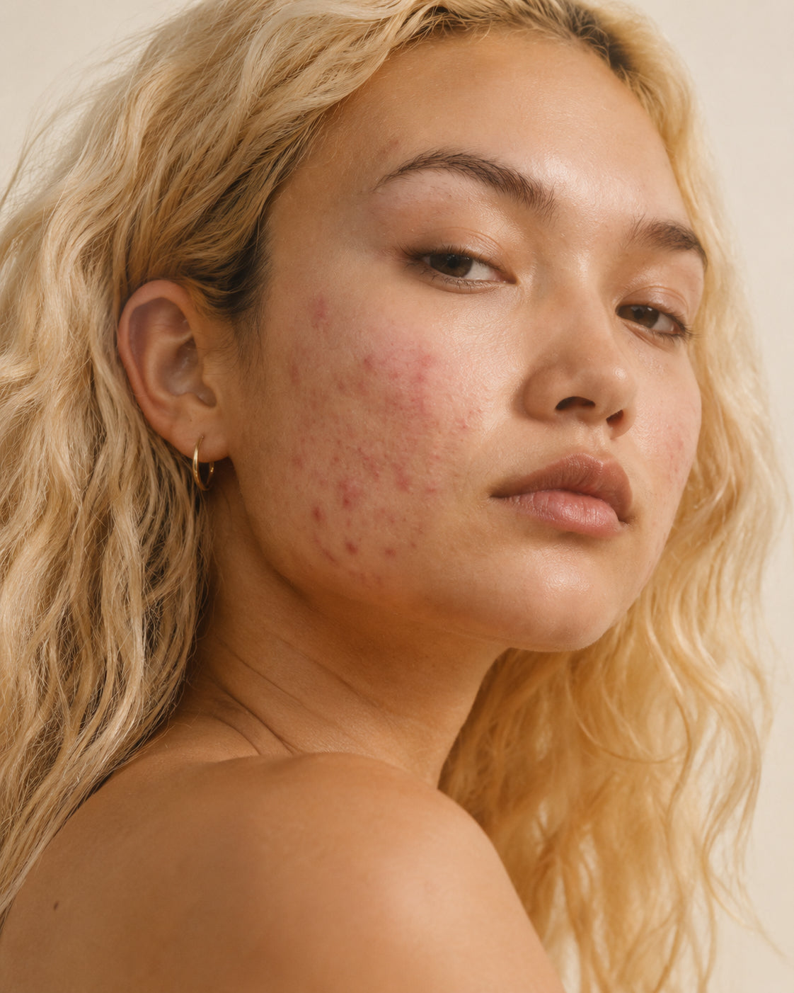 Post-inflammatory erythema, Fitzpatrick III skin, close-up showing flat pink to red macules where breakouts used to be