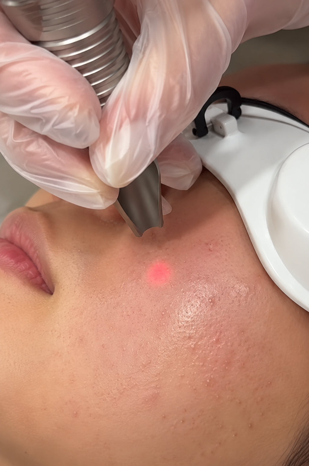 Long-pulsed Nd:YAG laser spot treatment in action, Pink Laser Clinics Doncaster Melbourne