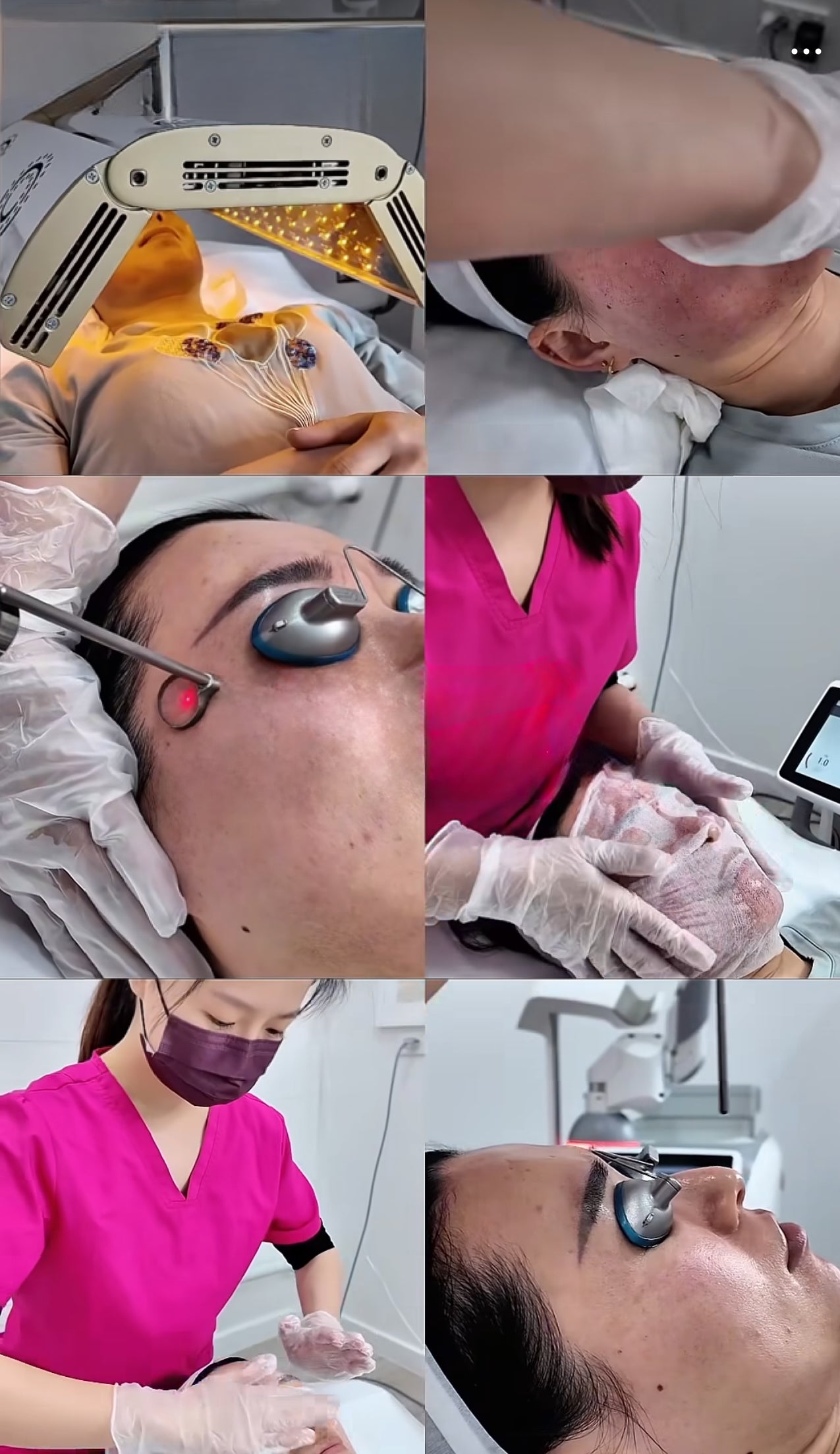 Treatment-process photograph, scar revision protocol, Pink Laser Clinics Doncaster