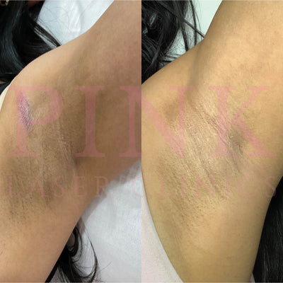 Body Lightening Packages - Underarms