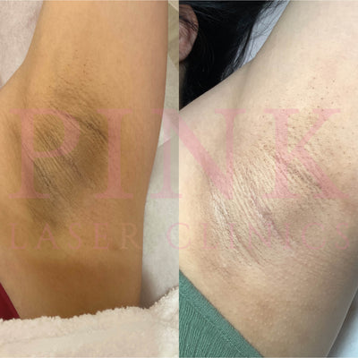 Body Lightening Packages - Underarms