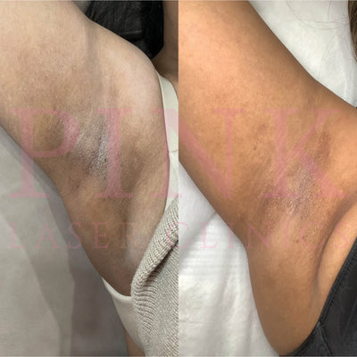 Body Lightening Packages - Underarms