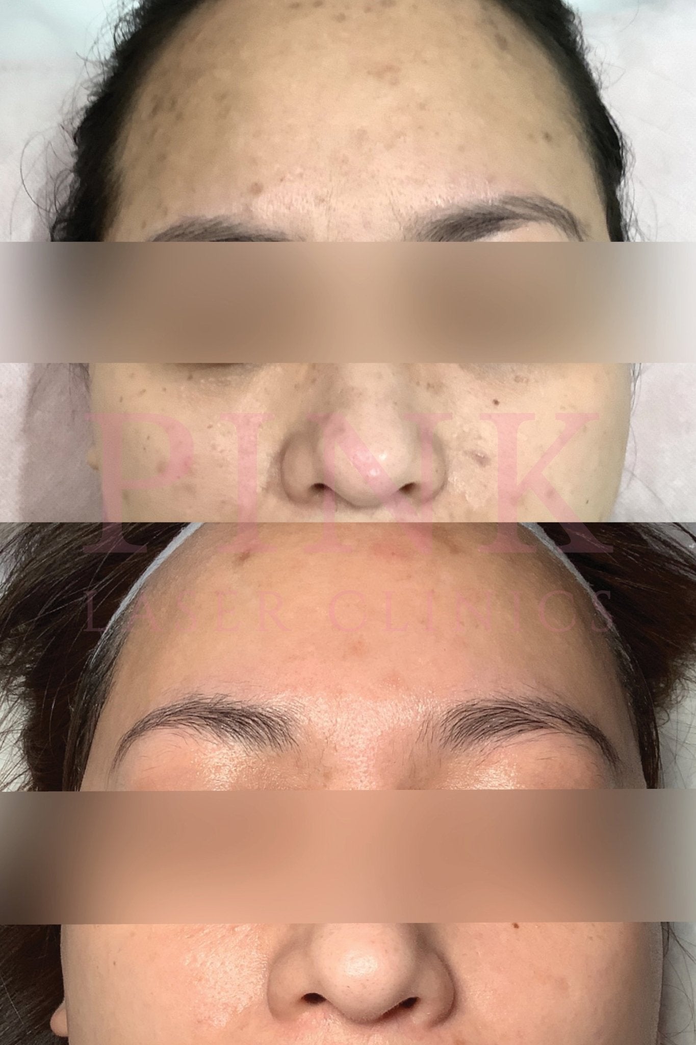 Before and after pigmentation treatment at Pink Laser Clinics. Post-inflammatory pigmentation following acne, visibly reduced.