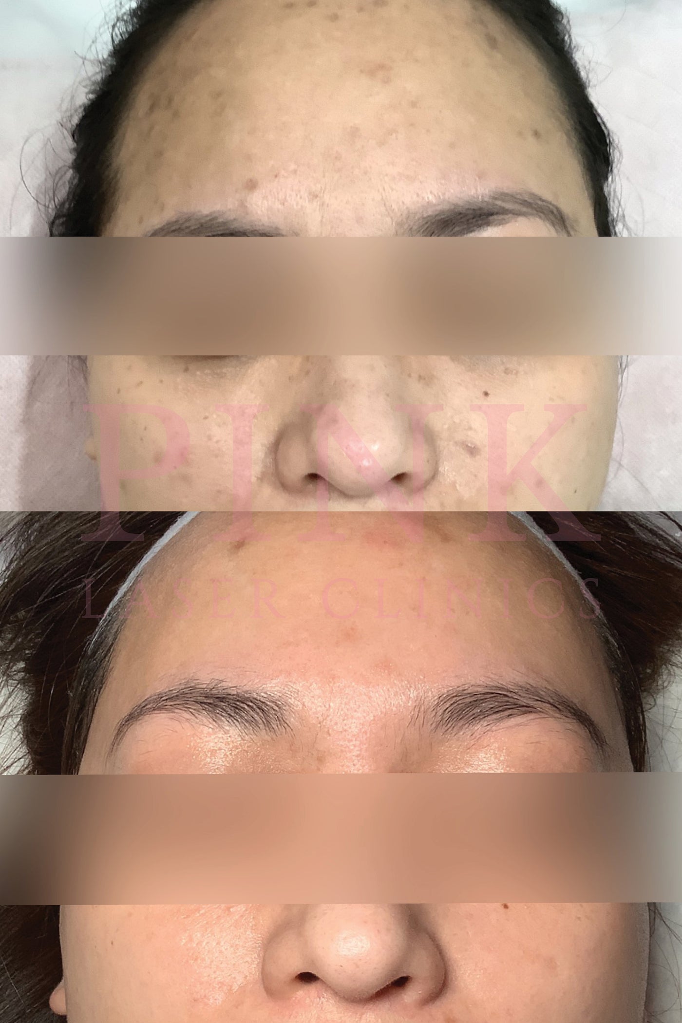 Dermal Pigmentation Removal