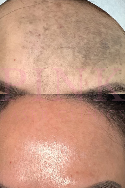 Dermal Pigmentation Removal