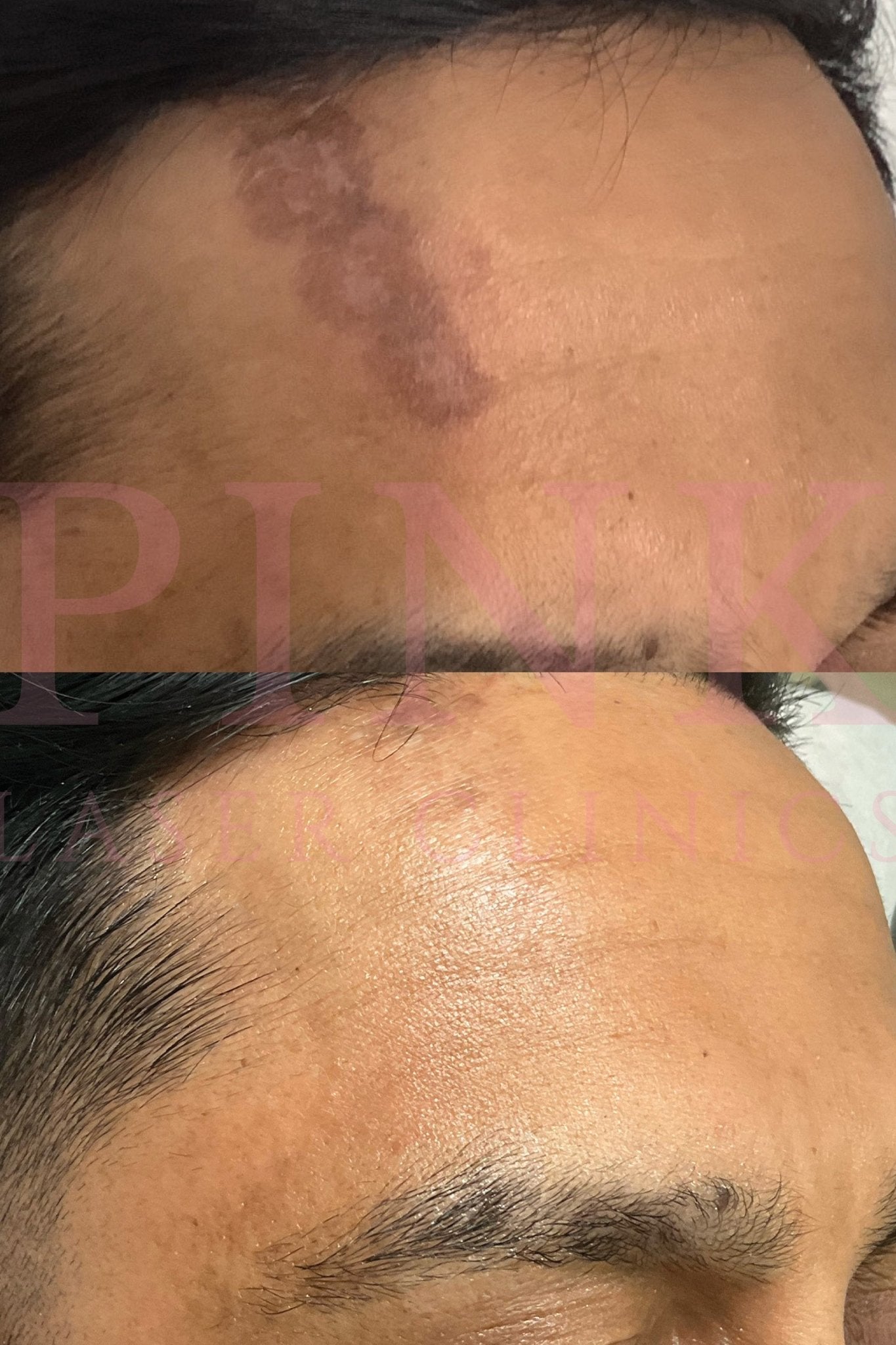 Before and after pigmentation treatment at Pink Laser Clinics. Post-burn pigmentation, visibly reduced.