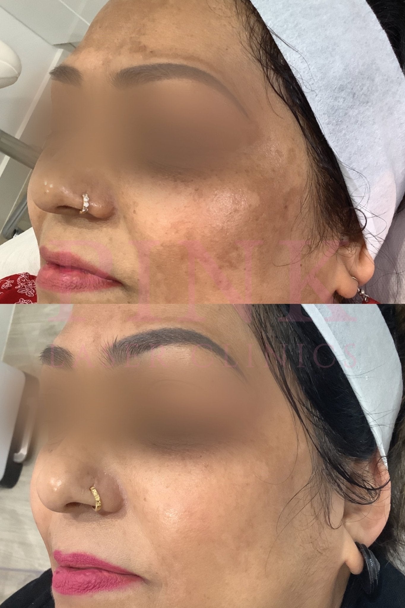 Before and after pigmentation treatment at Pink Laser Clinics. Facial pigmentation, visibly reduced.
