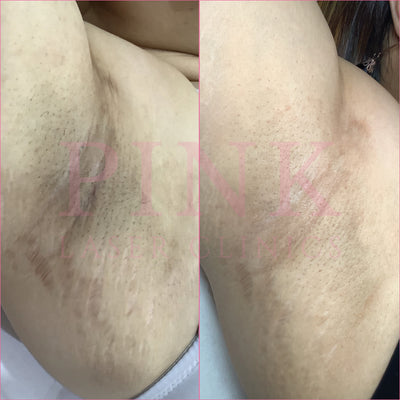 Body Lightening Packages - Underarms