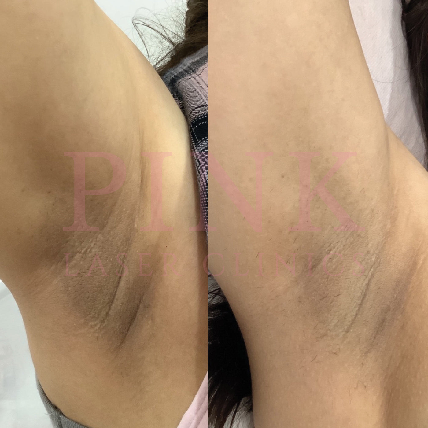 Body Lightening Packages - Underarms
