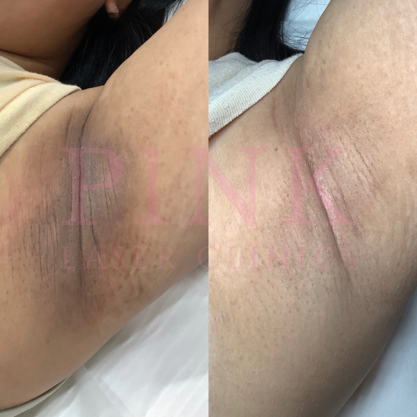 Body Lightening Packages - Underarms