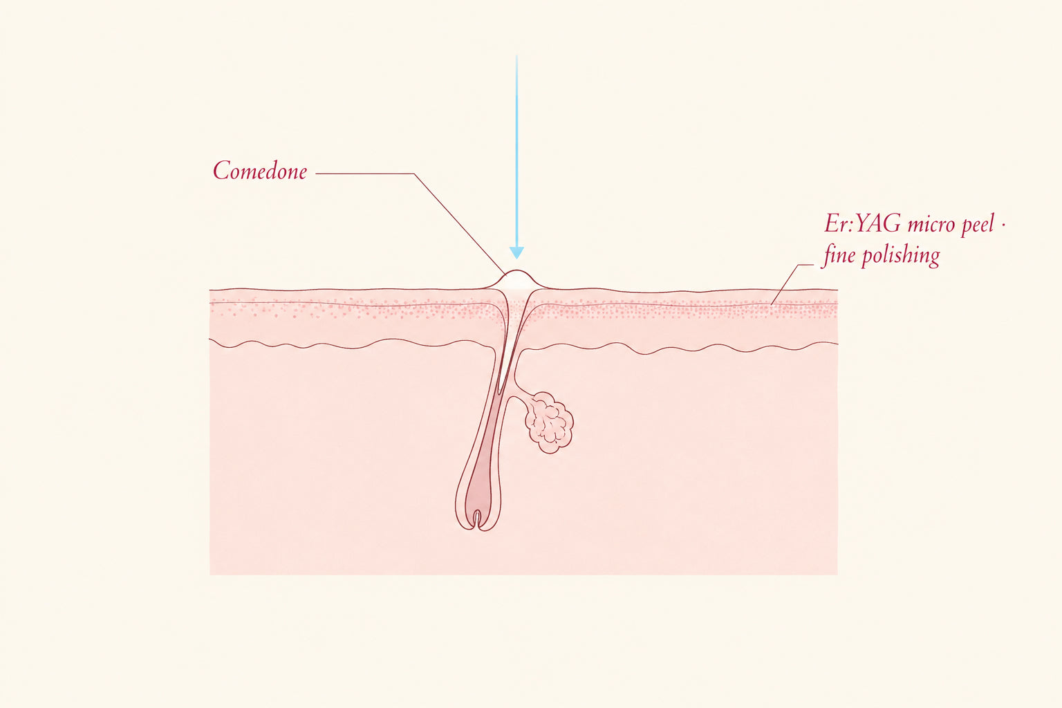 Skin cross-section diagram showing Er:YAG micro peel refining the keratinised follicular opening, Pink Laser Clinics
