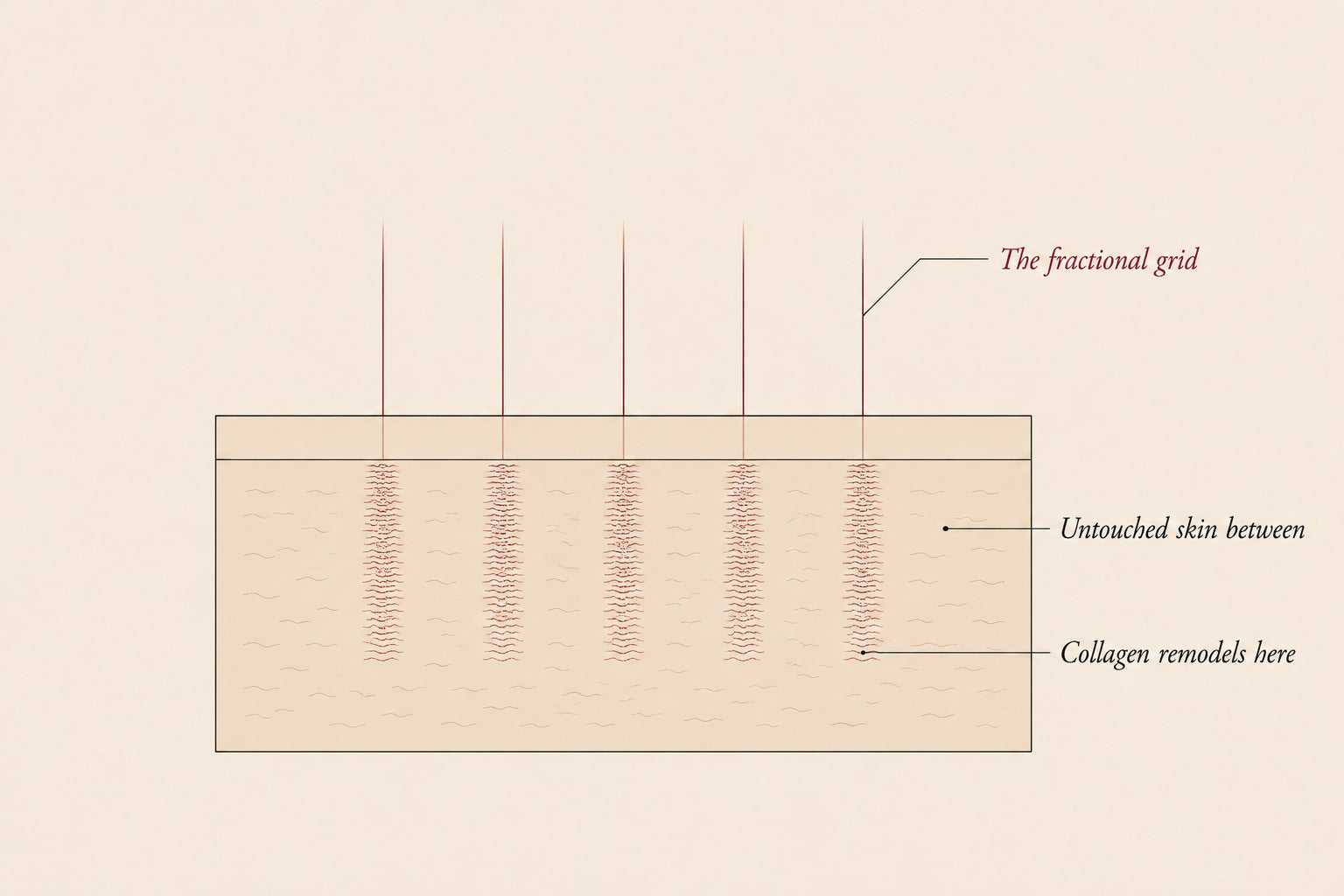 Skin cross-section diagram showing FracRevive's fractional grid of microscopic laser treatment columns with untouched skin between them, Pink Laser Clinics.