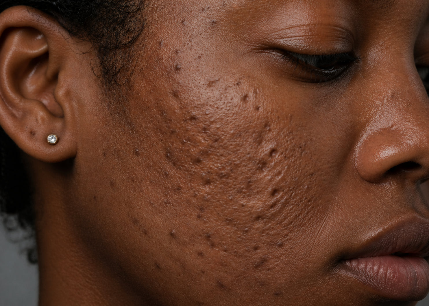 Acne scar revision at Pink Laser Clinics