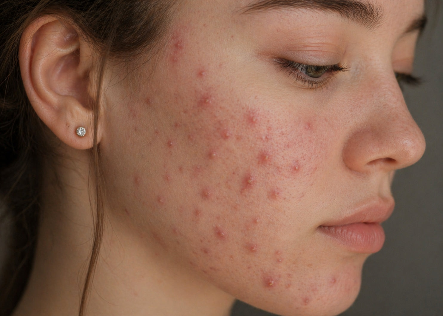 Active acne treatment at Pink Laser Clinics