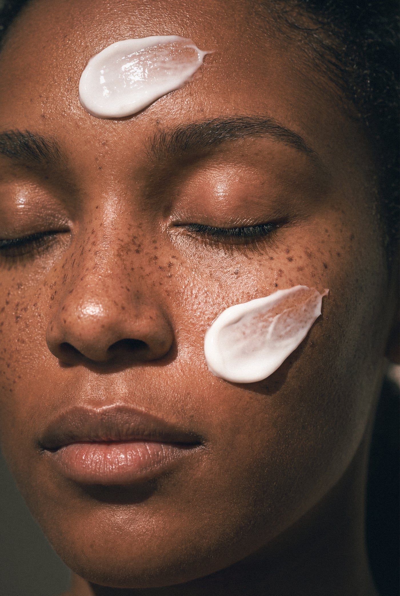 How to Keep Freckles From Coming Back After Laser.