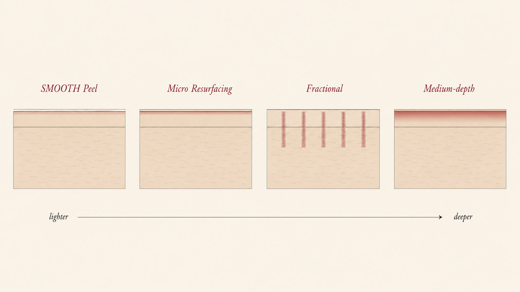 Calibration ladder diagram, four skin cross-sections showing the Er:YAG laser dialled across SMOOTH Peel, Micro Resurfacing, Fractional and Medium-depth treatment depths, Pink Laser Clinics.