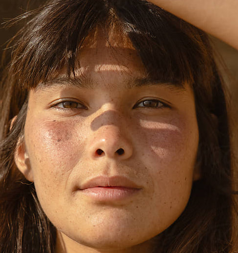 Melasma patches on cheeks, soft light.