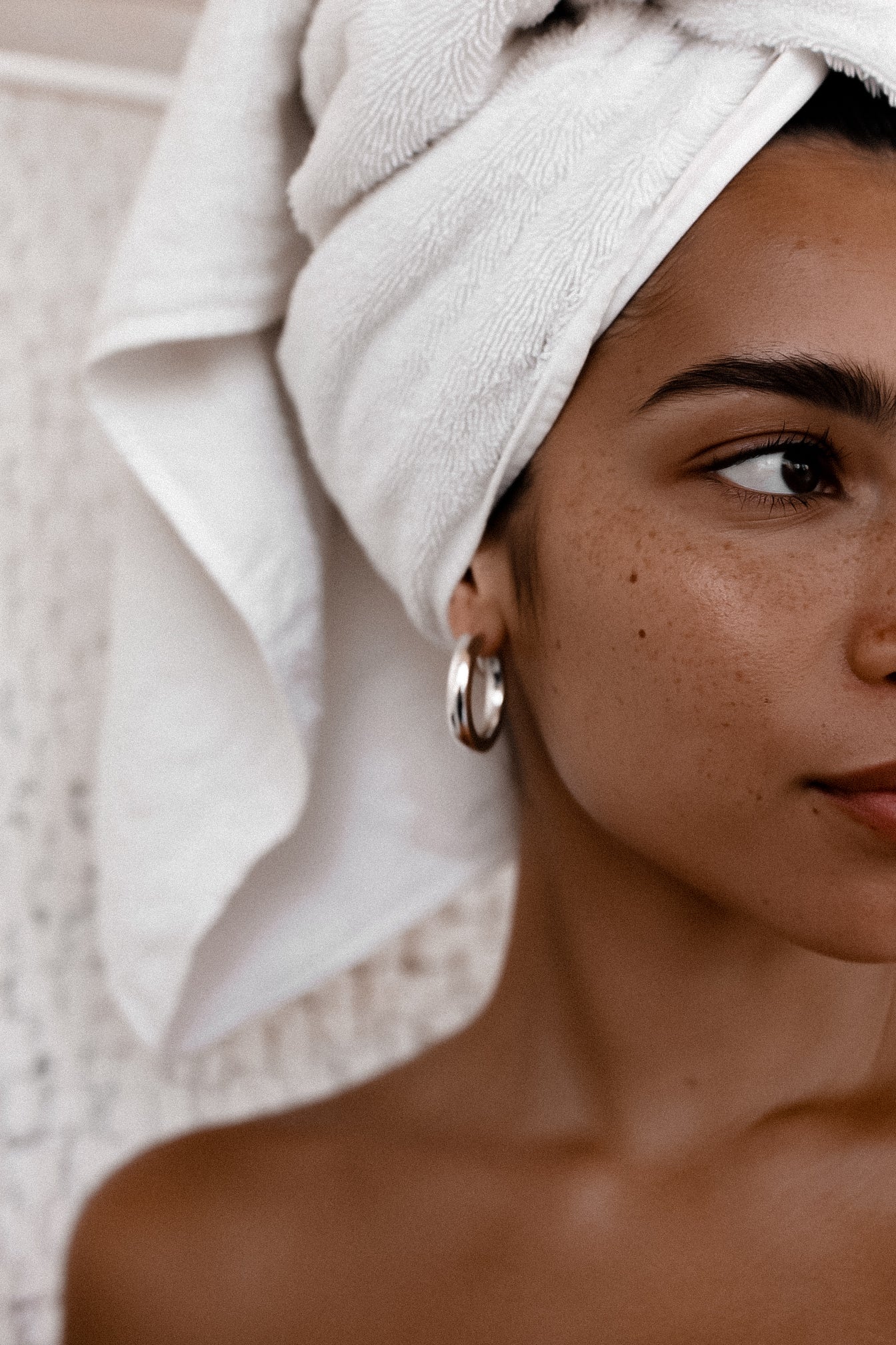 Post-inflammatory hyperpigmentation after acne, close-up.