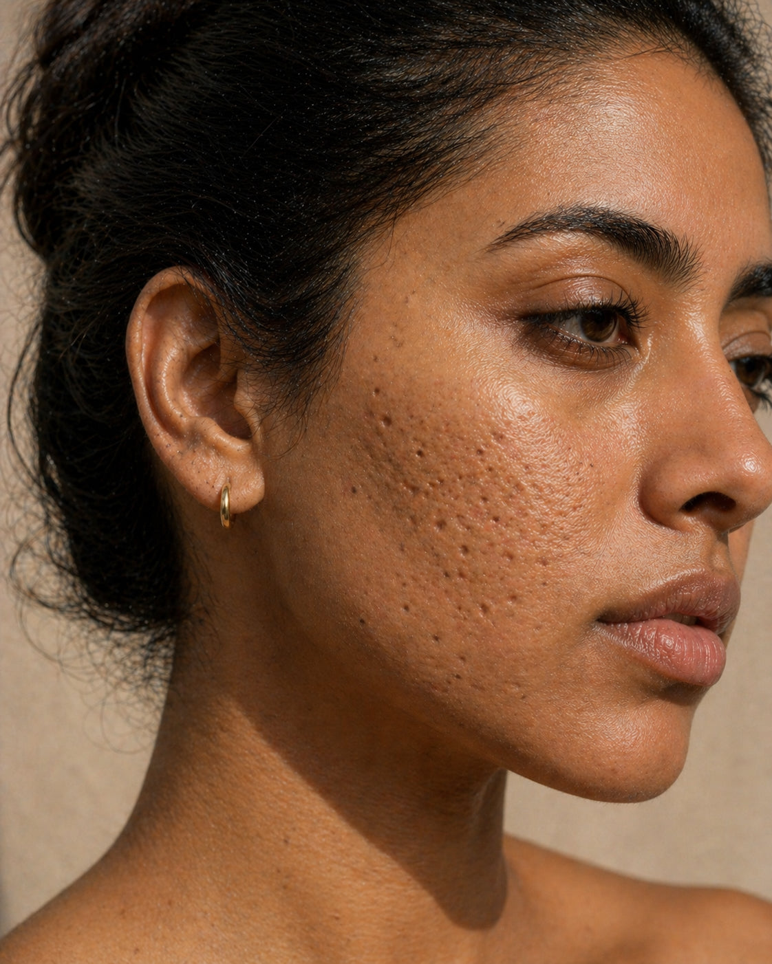 Deep boxcar acne scar morphology, Fitzpatrick IV skin, close-up showing deeper vertical-walled depressions on the cheek