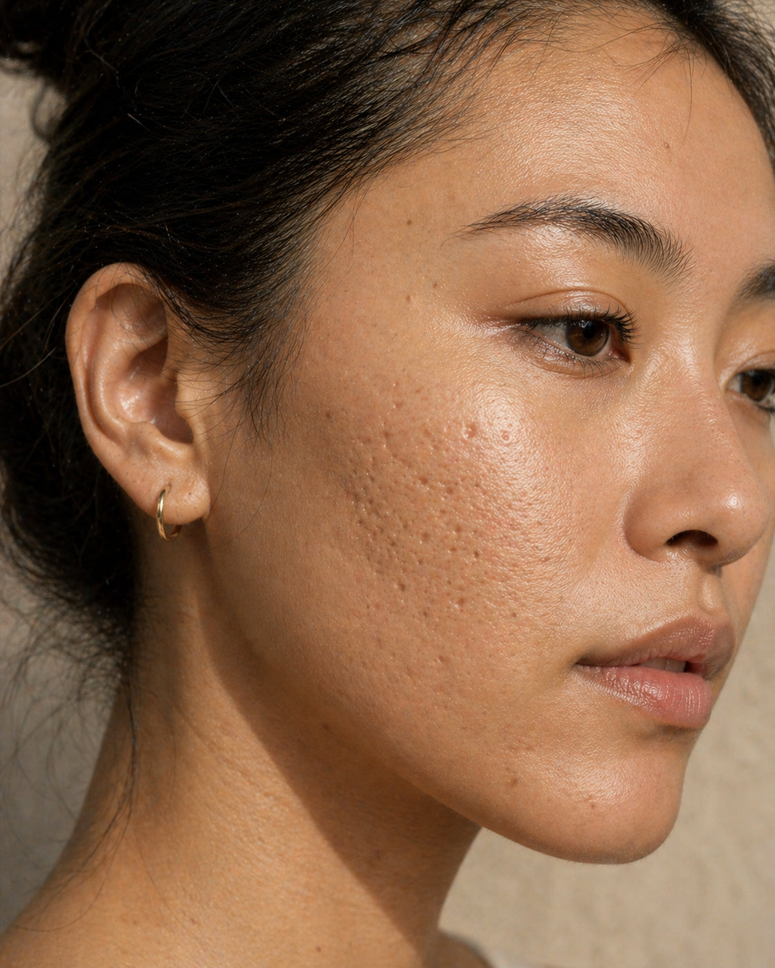 Shallow boxcar acne scar morphology, Fitzpatrick III skin, close-up showing round to oval depressions with sharp vertical walls