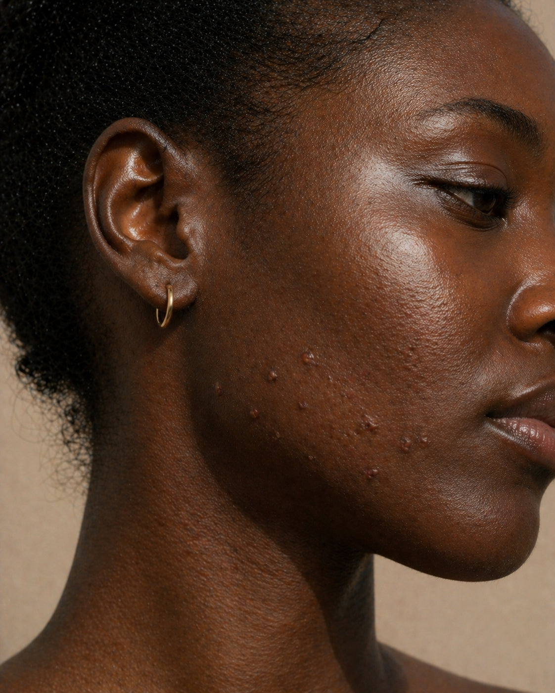 Hypertrophic acne scar morphology, Fitzpatrick VI skin, close-up showing raised firm scar tissue along the jawline