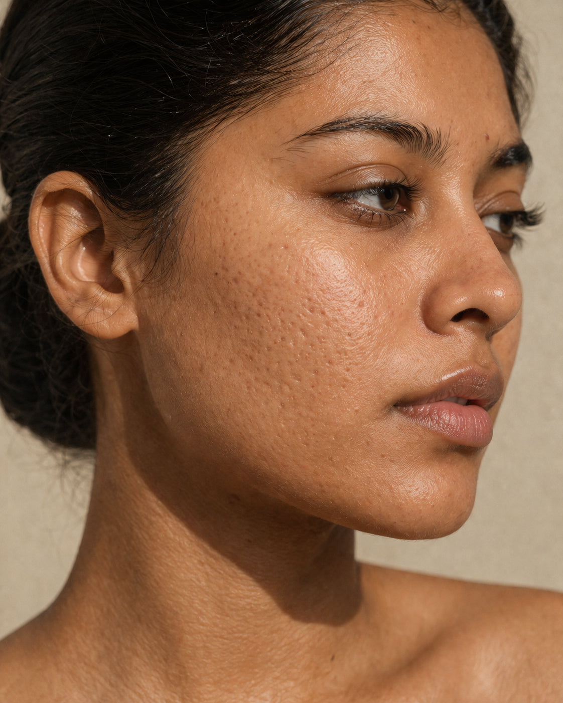 Icepick acne scar morphology, Fitzpatrick IV skin, close-up showing narrow vertical pinpoint indentations on the cheek