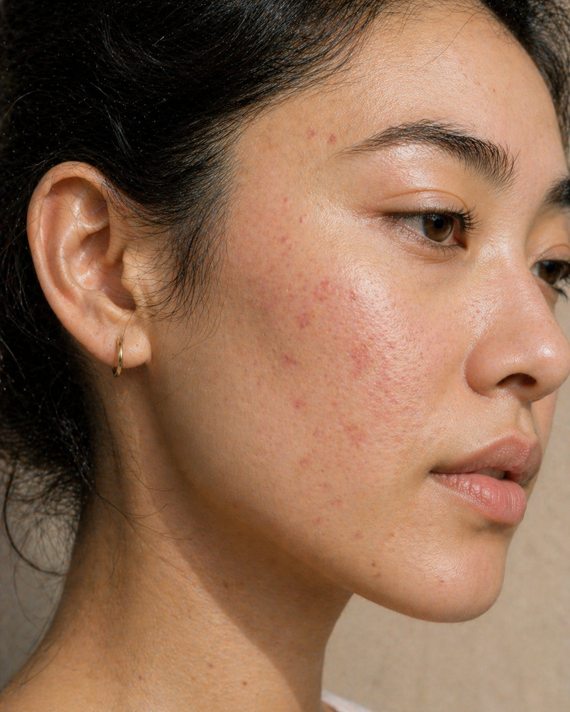 Post-inflammatory erythema, Fitzpatrick III skin, close-up showing flat pink to red macules where breakouts used to be