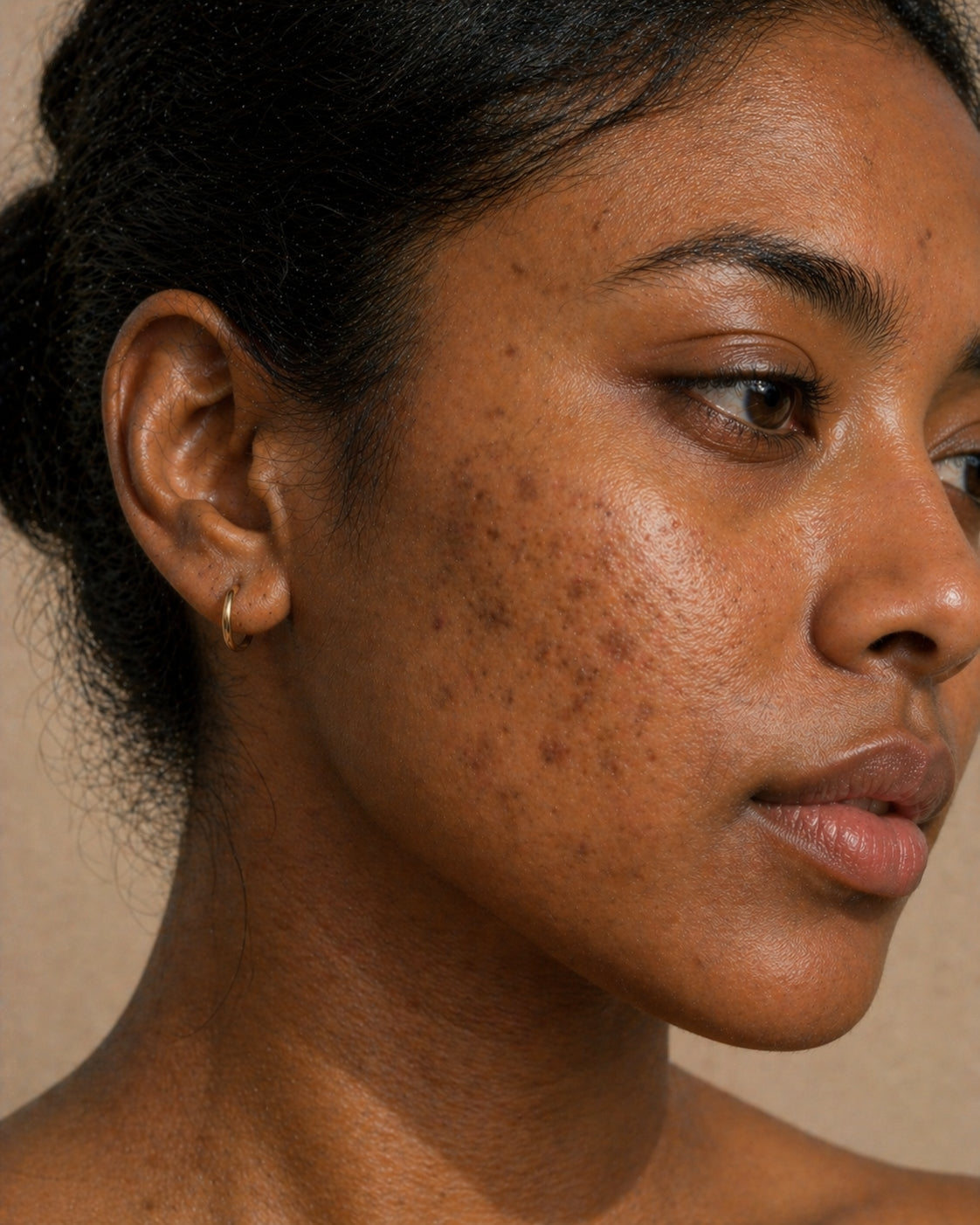 Post-inflammatory hyperpigmentation, Fitzpatrick V skin, close-up showing flat brown macules where breakouts used to be