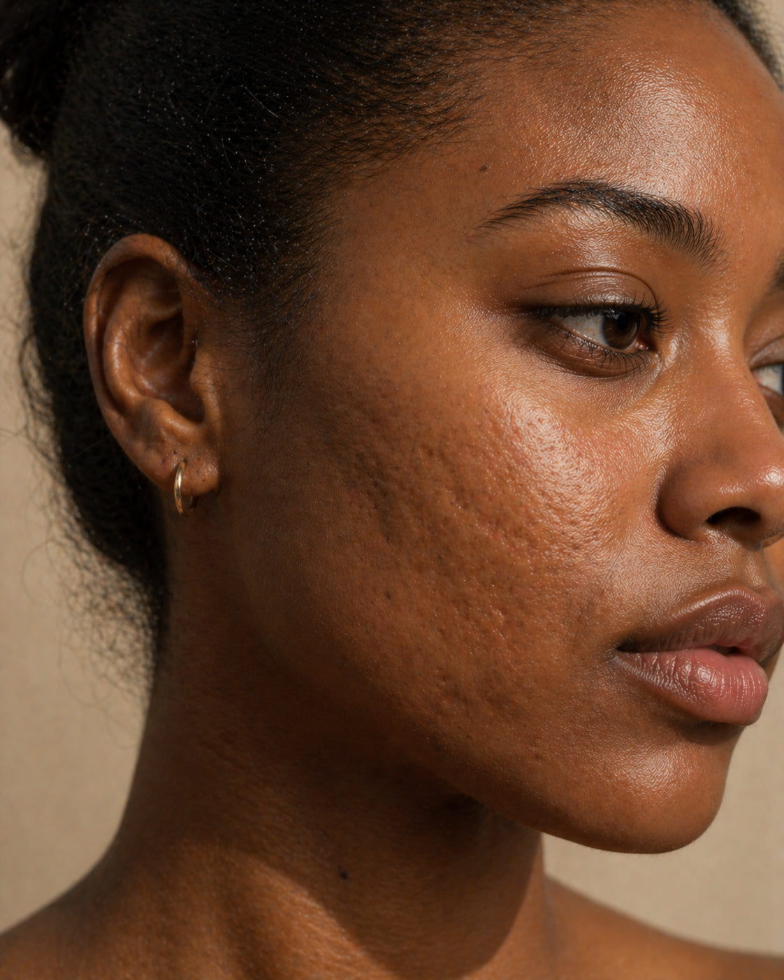 Rolling acne scar morphology, Fitzpatrick V skin, close-up showing wide shallow undulating depressions on the cheek