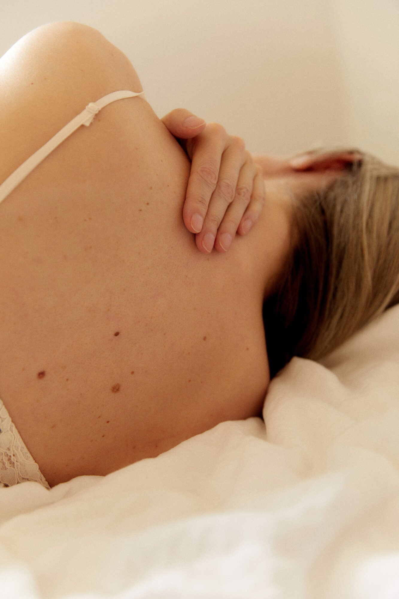 Seborrhoeic keratoses. What they are, and why they appear.