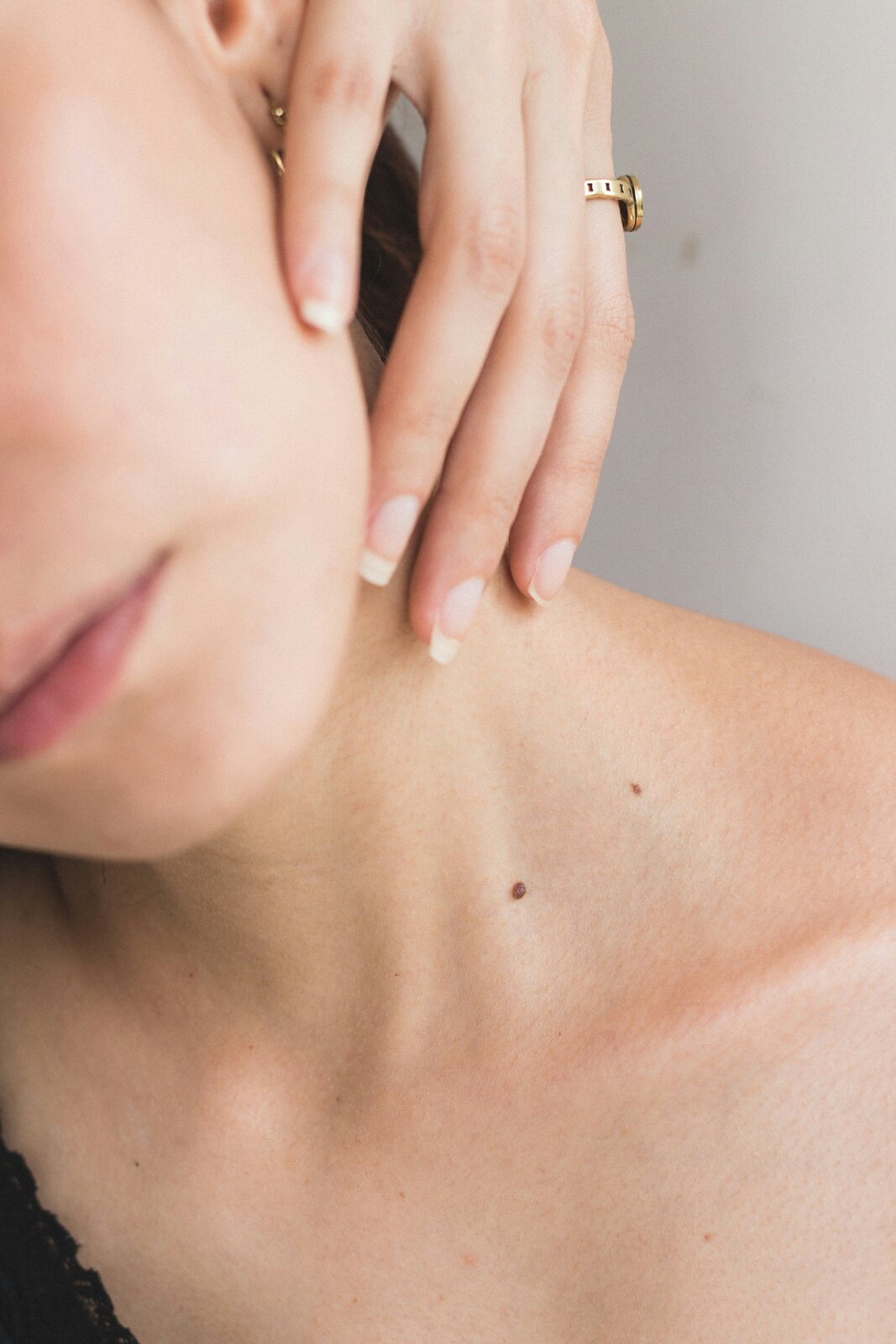 Editorial close study of a raised mole on the neck, cosmetic mole removal at Pink Laser Clinics in Doncaster