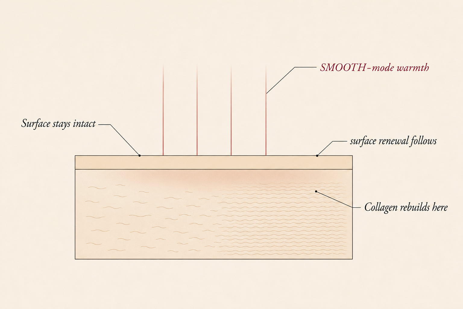 Skin cross-section diagram showing SMOOTH-mode laser warmth reaching the collagen layer beneath an intact skin surface, Pink Laser Clinics.