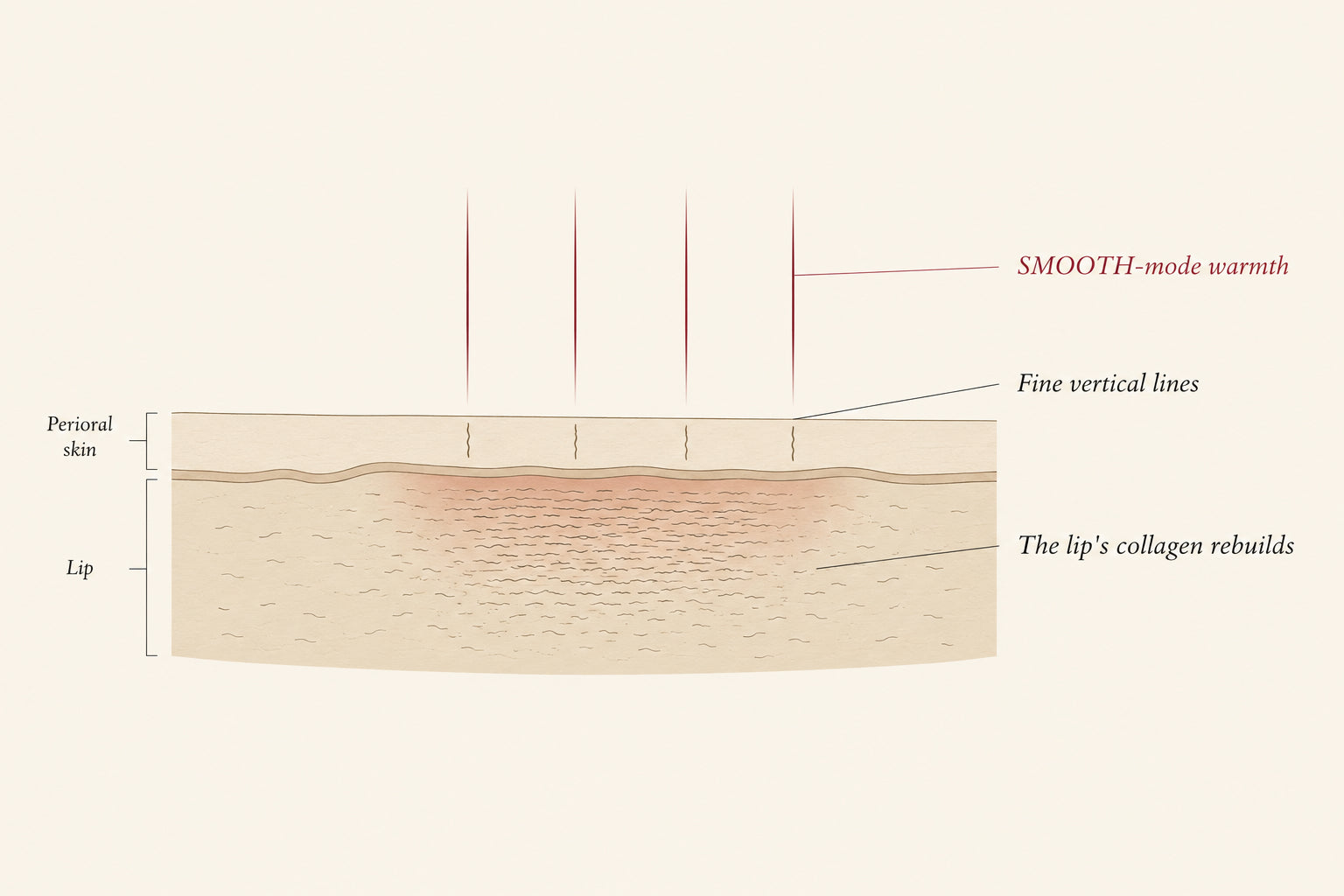 Lip and perioral skin cross-section diagram showing SMOOTH-mode warmth reaching the collagen layer, the surface staying intact, Pink Laser Clinics.