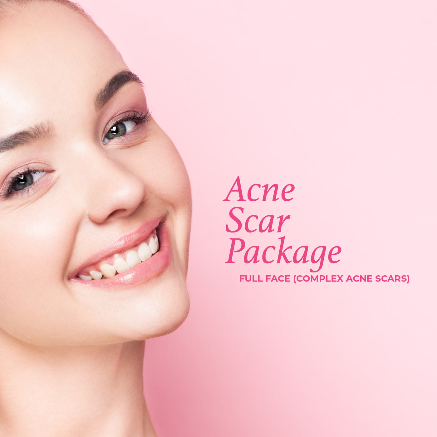 Acne Scar Package - Full Face (complex scars)